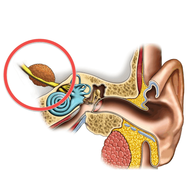 听神经瘤（听神经鞘瘤）