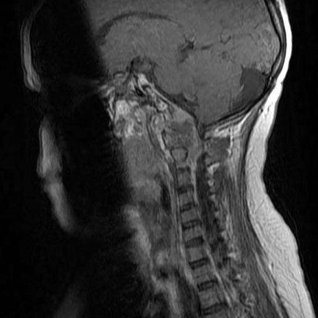脑脊索瘤治愈率是多少？合理治疗后可超过80%
